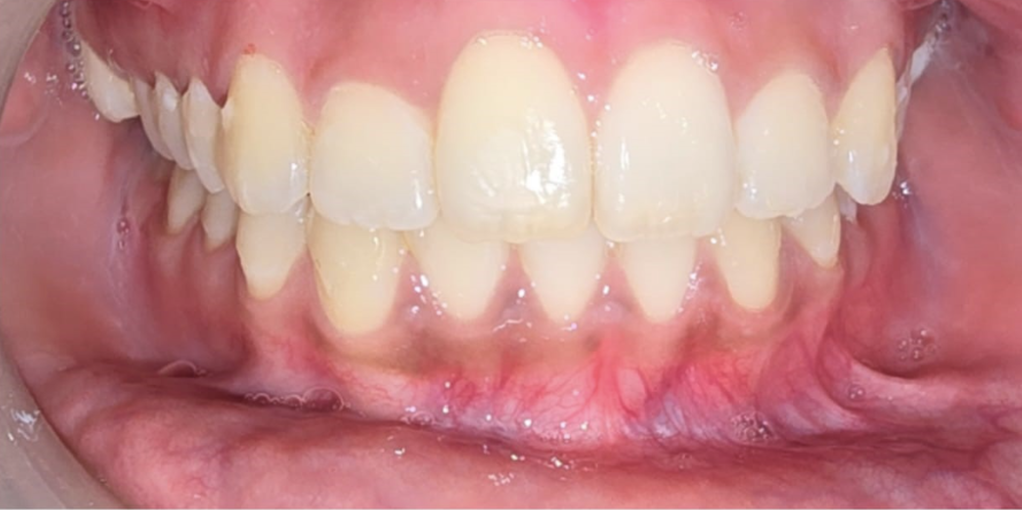 Invisible Aligners, Smooth Teeth: Nishani's Clear Plus Story